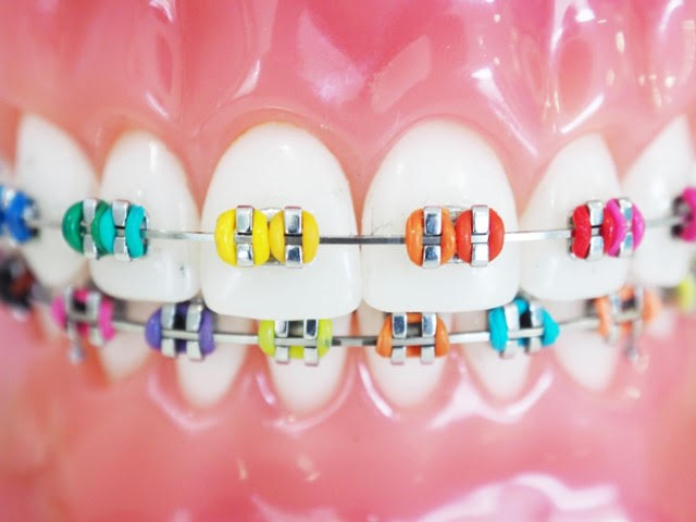 Featured image for “Metal Braces”