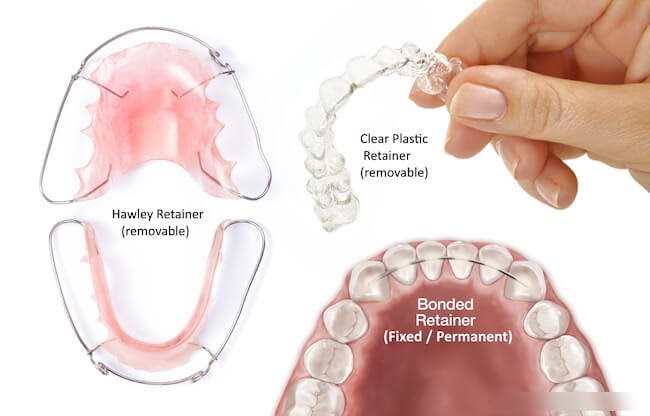 Featured image for “Retainers”